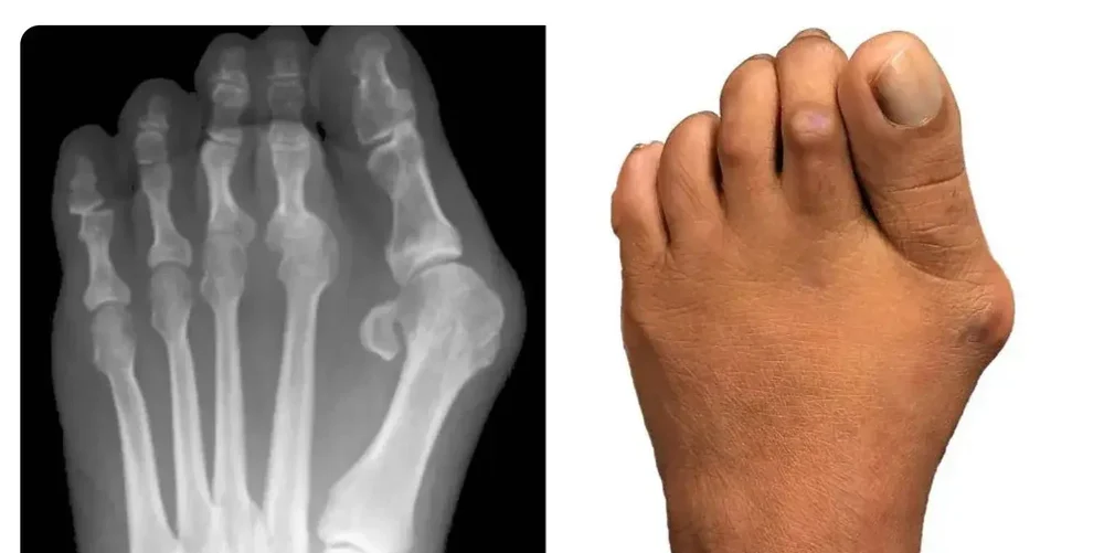 Gesunder Fuß / Hallux valgus